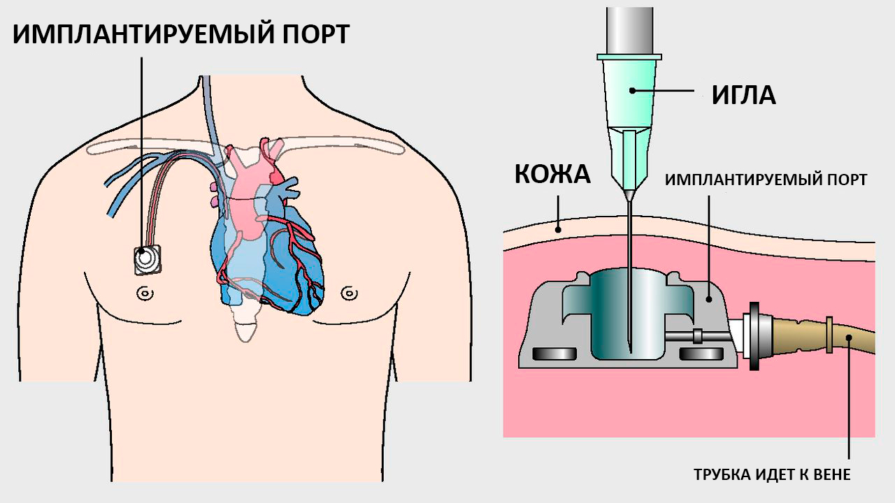 процесс установки порт-системы